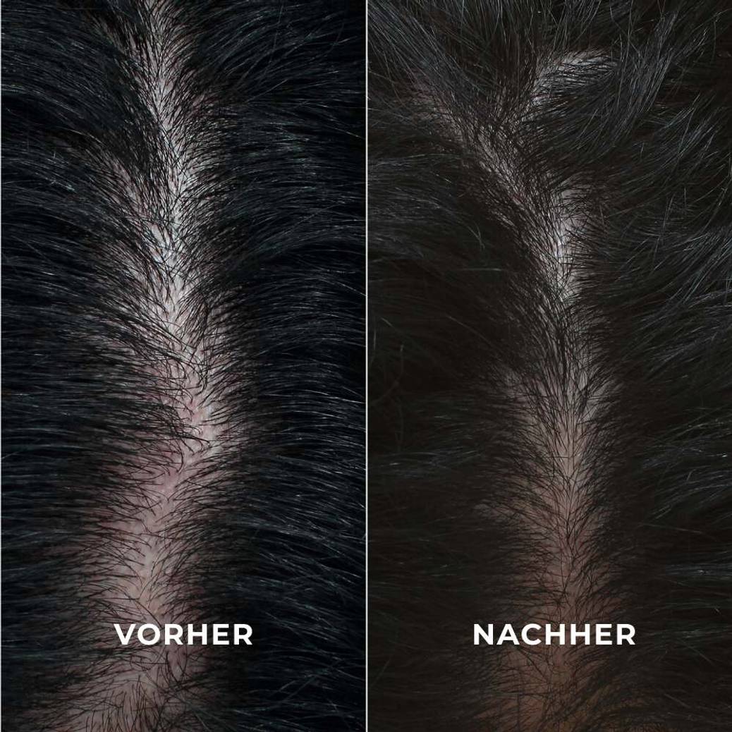 Intensive Anti-Haarausfall Verdichtungskur